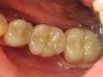 Dental Bridges for Teeth