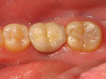Dental Implants for Teeth