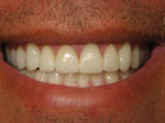 Dental Veneers for Teeth