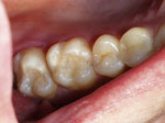 Tooth-Colored Fillings for Teeth