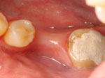 Dental Bridges for Teeth